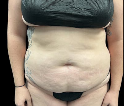 Liposuction Before & After Gallery - Patient 258816 - Image 1