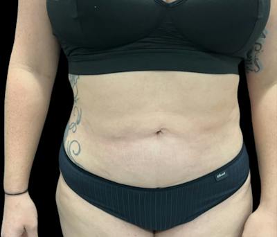 Liposuction Before & After Gallery - Patient 258816 - Image 2