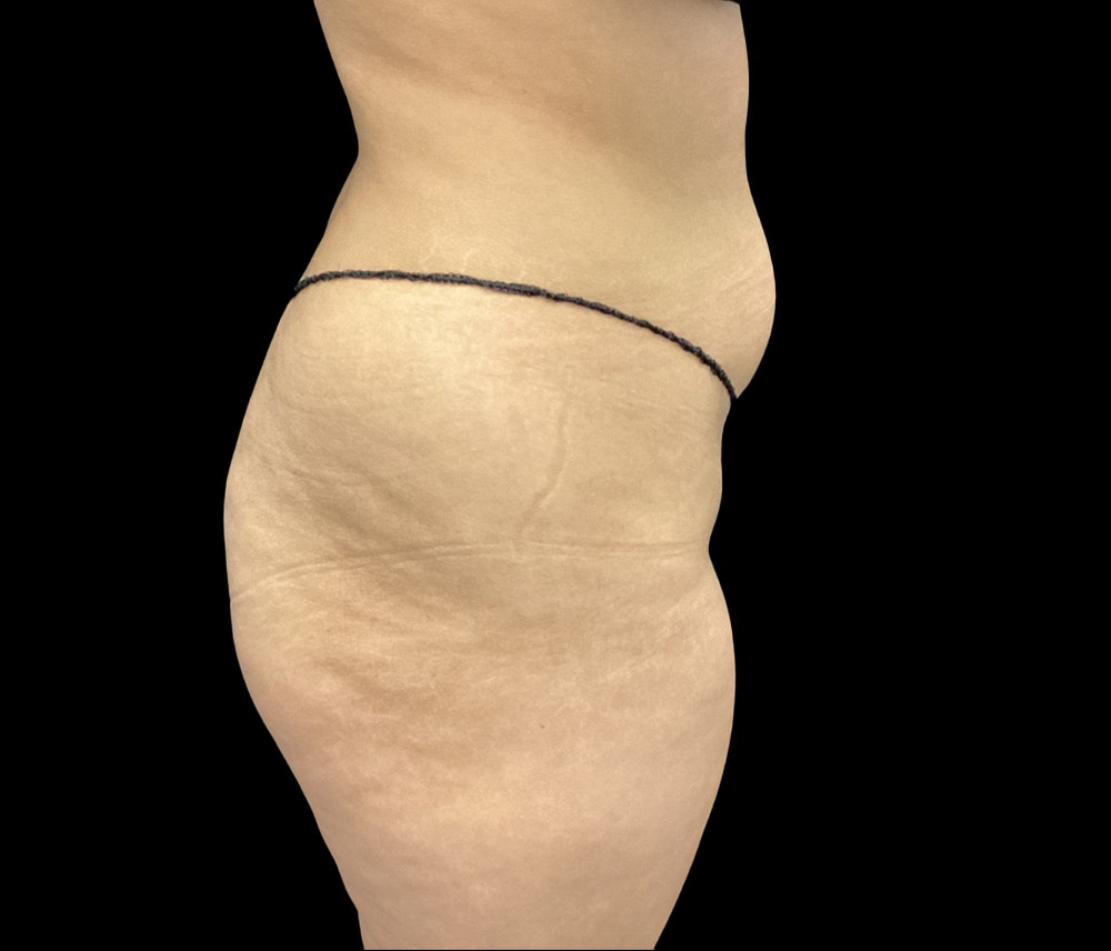 Liposuction Before & After Gallery - Patient 436078 - Image 3