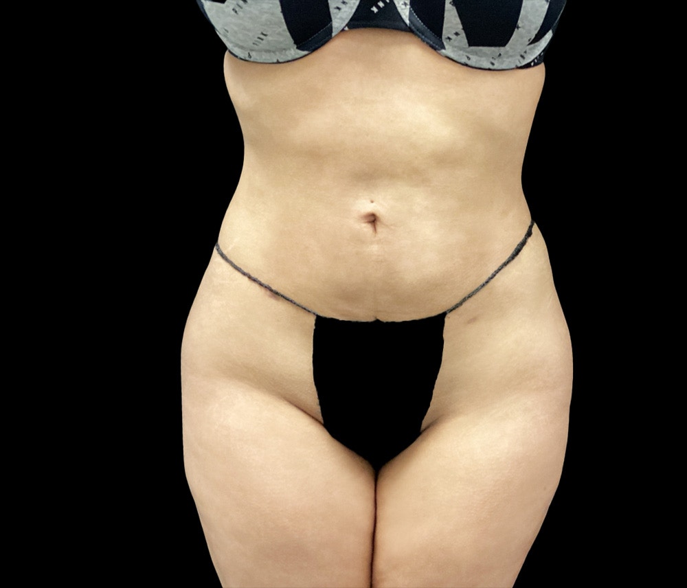 Liposuction Before & After Gallery - Patient 436078 - Image 2