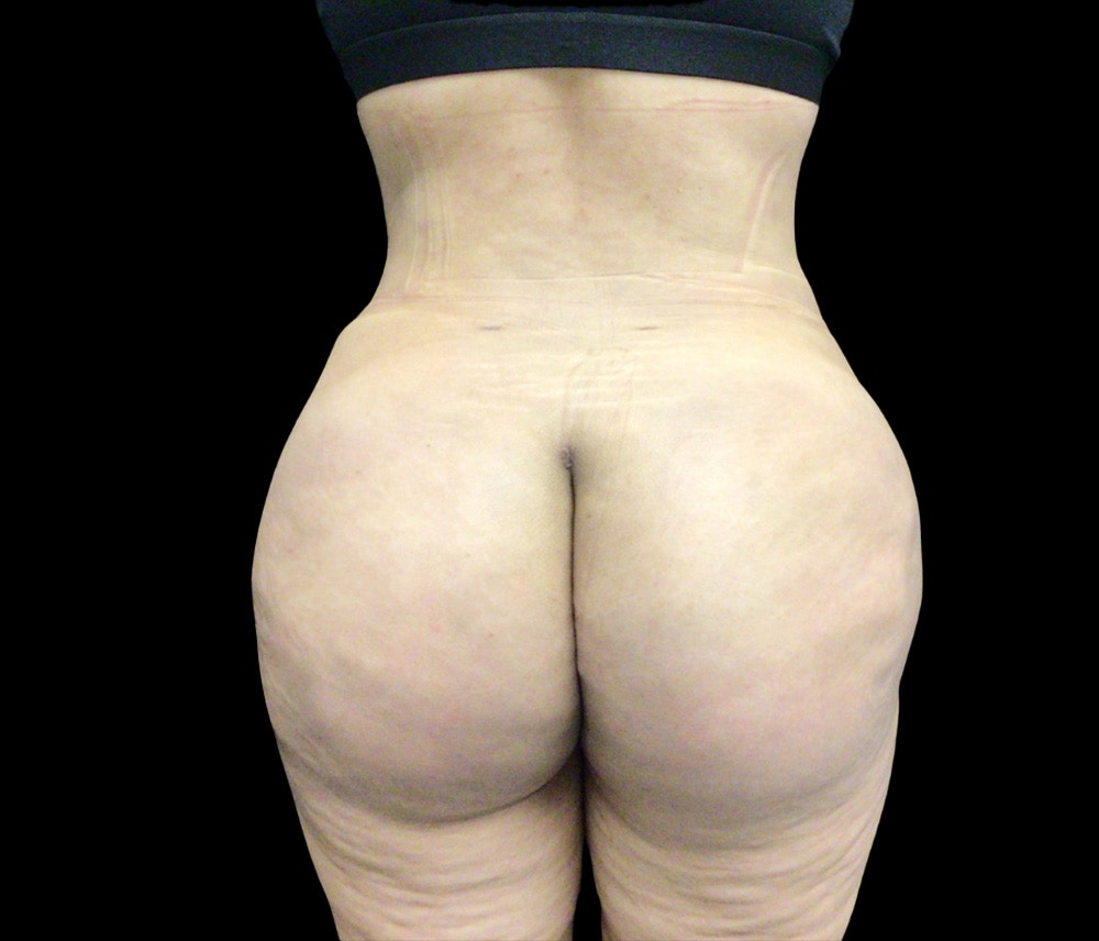 Liposuction Before & After Gallery - Patient 436078 - Image 6