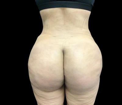Liposuction Before & After Gallery - Patient 436078 - Image 6