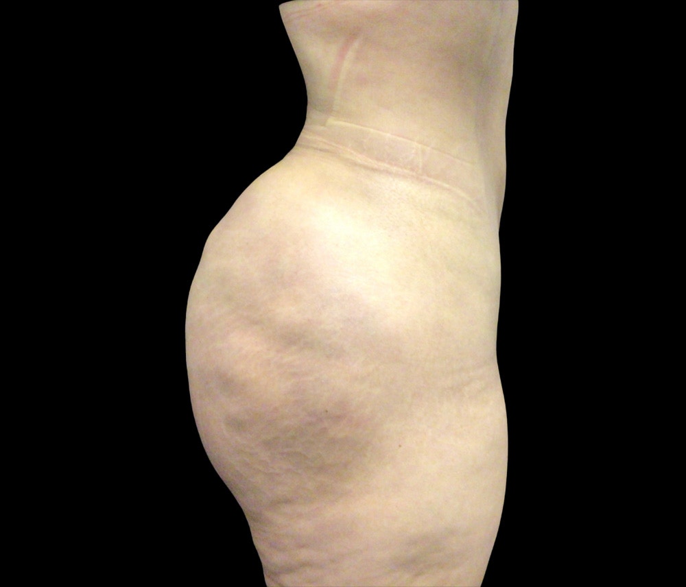 Liposuction Before & After Gallery - Patient 436078 - Image 4