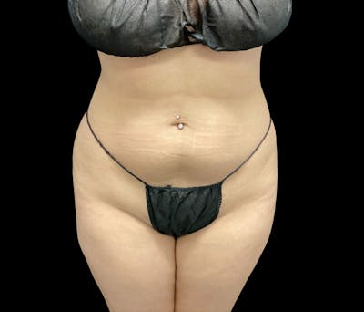 Liposuction Before & After Gallery - Patient 436078 - Image 1