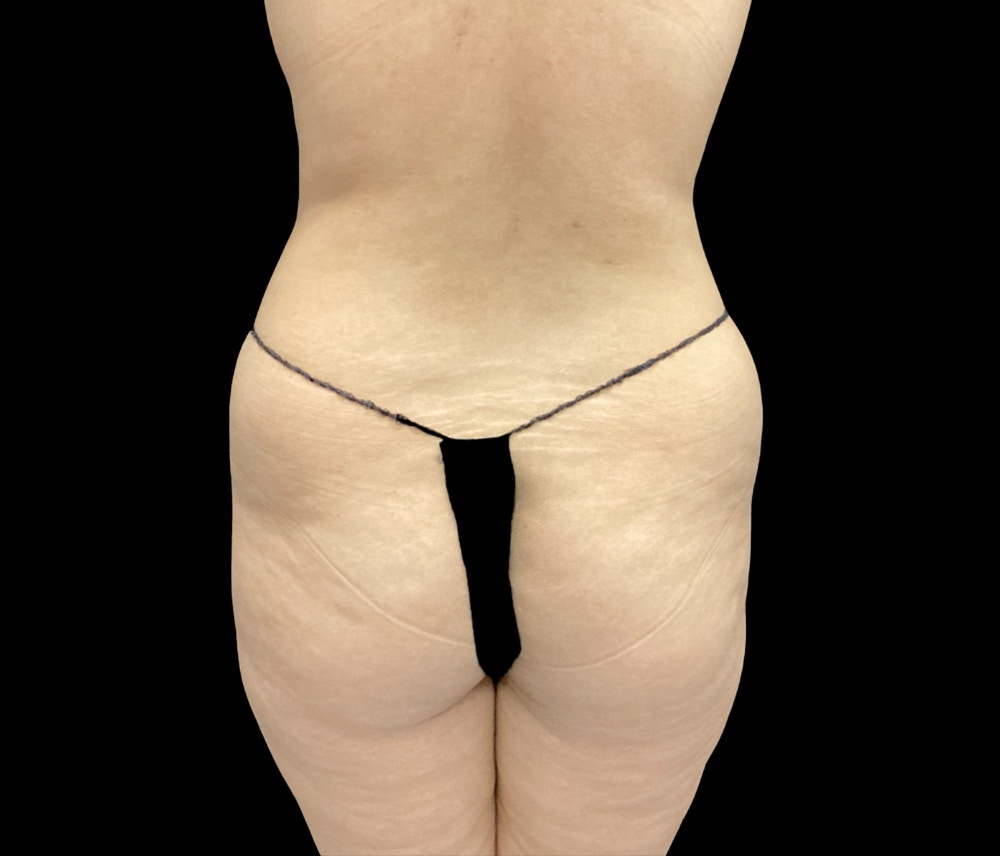 Liposuction Before & After Gallery - Patient 436078 - Image 5