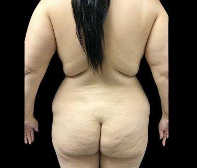 Liposuction Before & After Gallery - Patient 182646 - Image 3