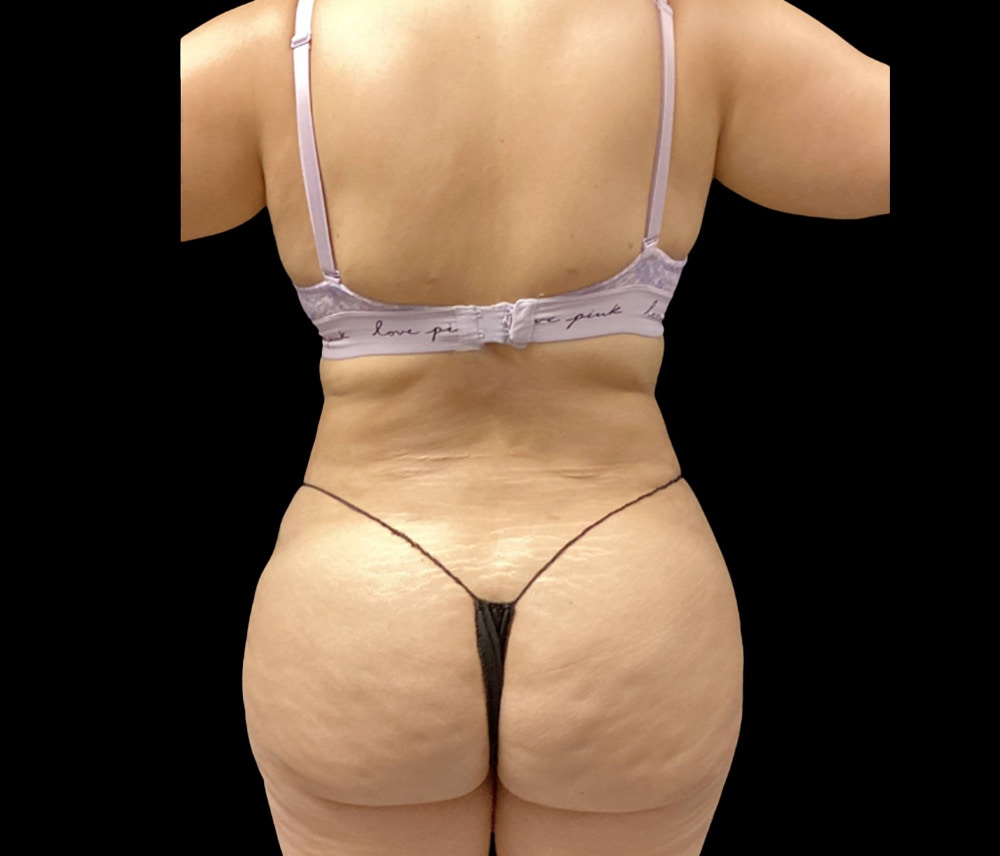 Liposuction Before & After Gallery - Patient 182646 - Image 4