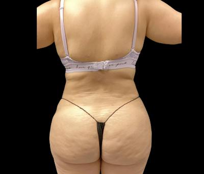 Liposuction Before & After Gallery - Patient 182646 - Image 4