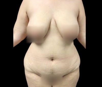 Liposuction Before & After Gallery - Patient 182646 - Image 1