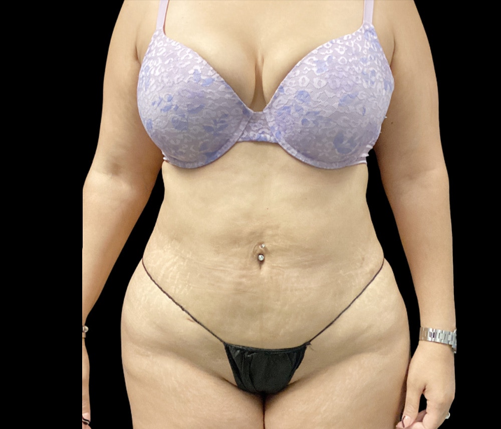 Liposuction Before & After Gallery - Patient 182646 - Image 2