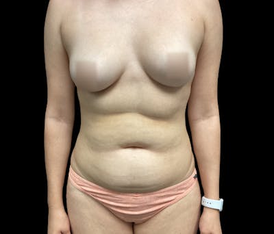 Liposuction Before & After Gallery - Patient 418866 - Image 1