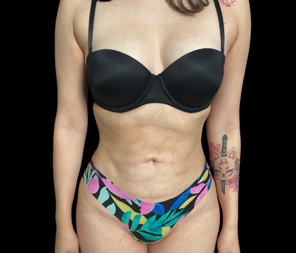 Liposuction Before & After Gallery - Patient 418866 - Image 2