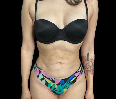 Liposuction Before & After Gallery - Patient 418866 - Image 2