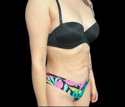 Liposuction Before & After Gallery - Patient 418866 - Image 4