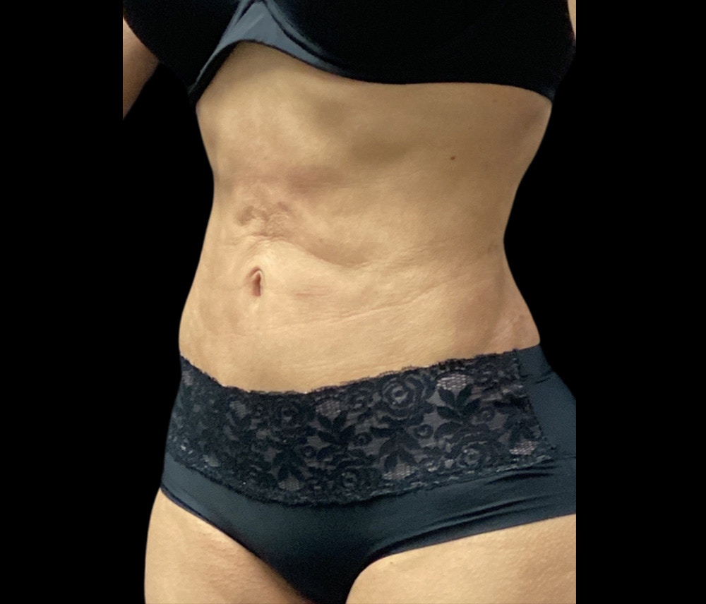 Liposuction Before & After Gallery - Patient 325263 - Image 6