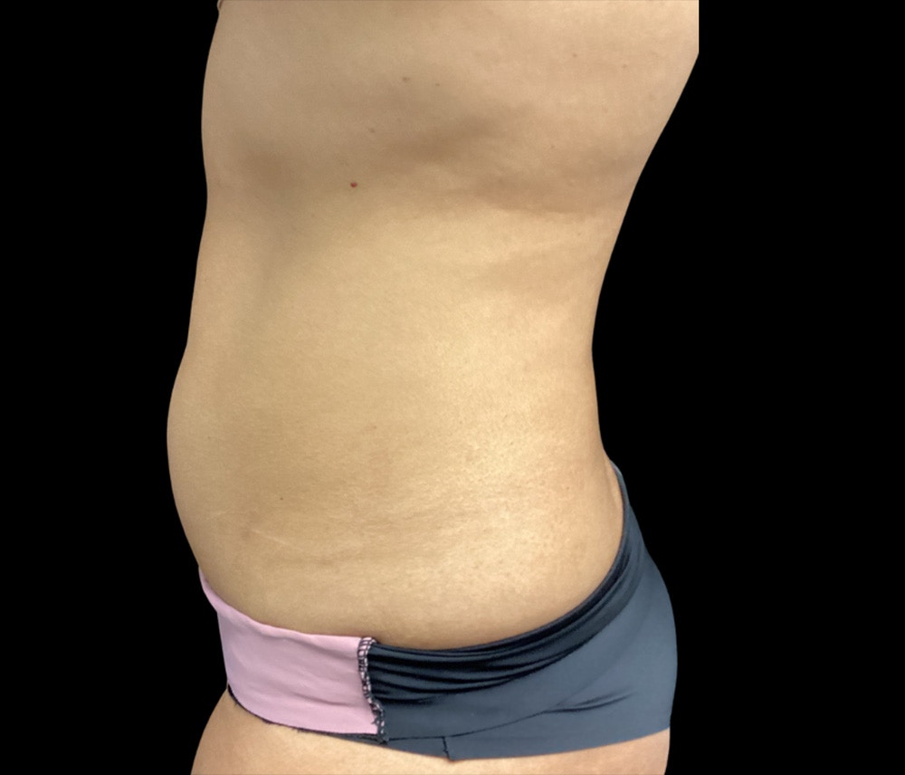 Liposuction Before & After Gallery - Patient 325263 - Image 7