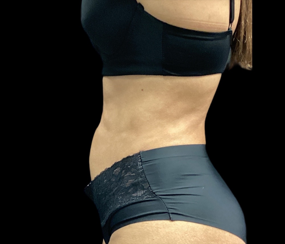 Liposuction Before & After Gallery - Patient 325263 - Image 8