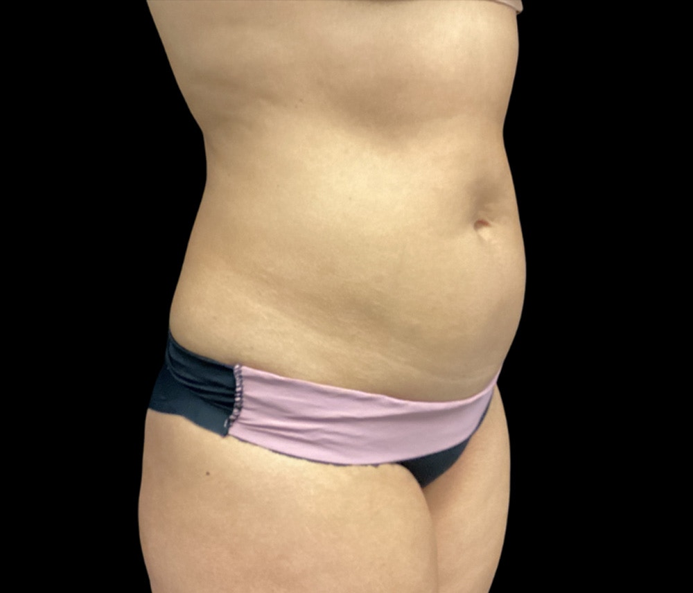 Liposuction Before & After Gallery - Patient 325263 - Image 3