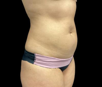 Liposuction Before & After Gallery - Patient 325263 - Image 3