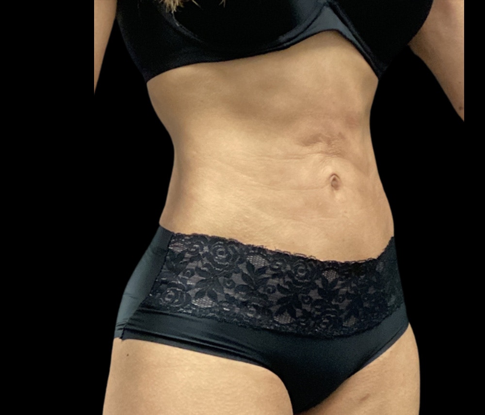 Liposuction Before & After Gallery - Patient 325263 - Image 4