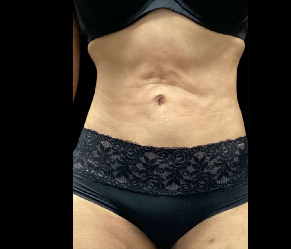 Liposuction Before & After Gallery - Patient 325263 - Image 2