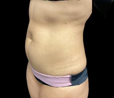 Liposuction Before & After Gallery - Patient 325263 - Image 5
