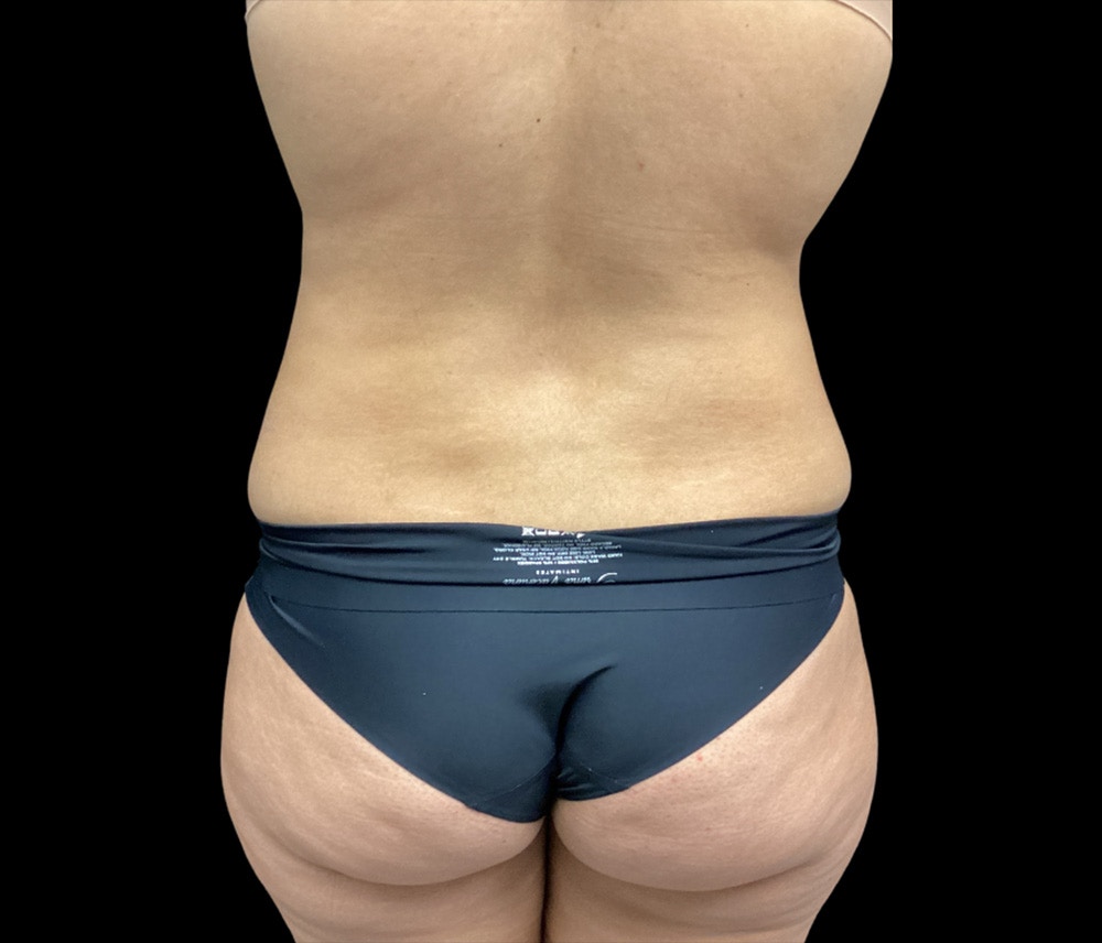 Liposuction Before & After Gallery - Patient 325263 - Image 9