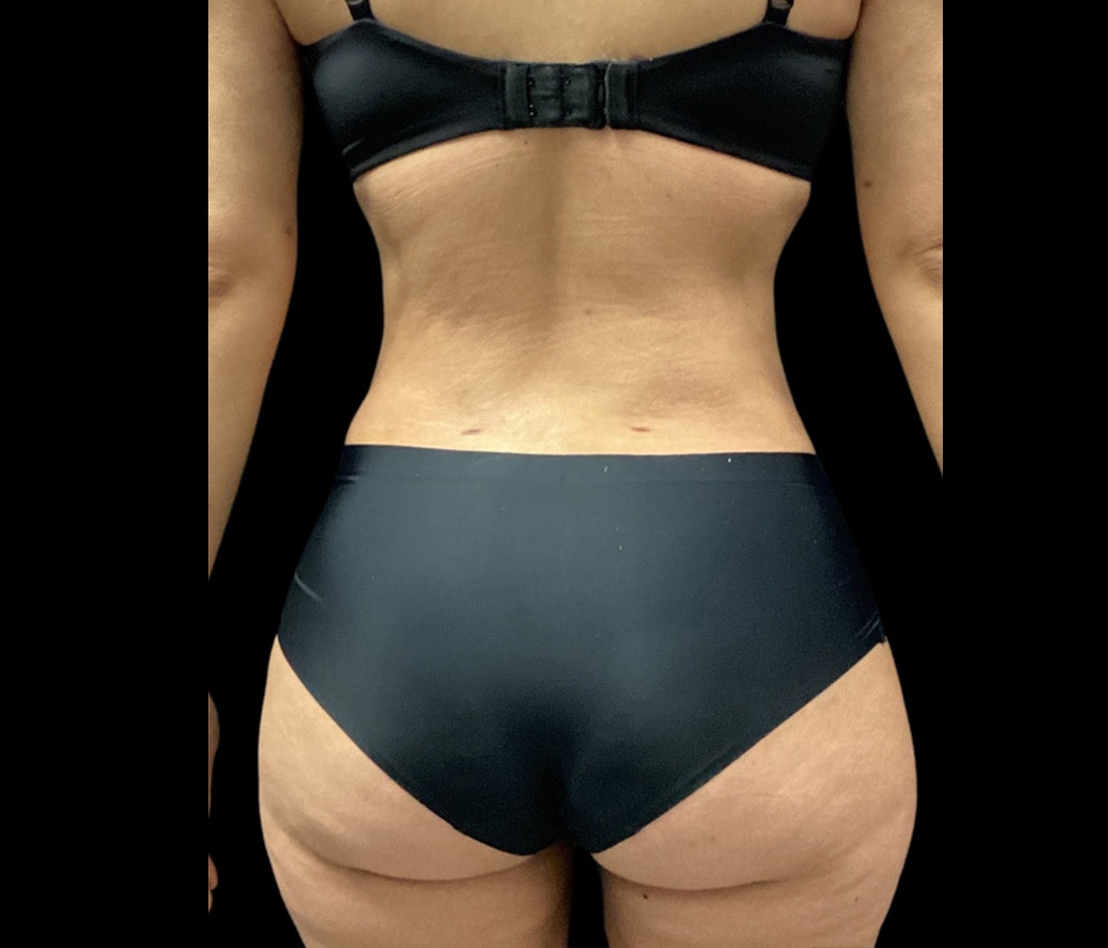 Liposuction Before & After Gallery - Patient 325263 - Image 10