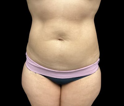 Liposuction Before & After Gallery - Patient 325263 - Image 1