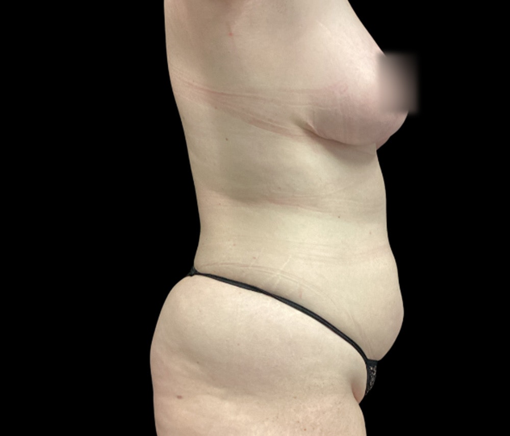Liposuction Before & After Gallery - Patient 332432 - Image 5