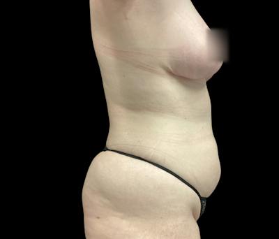 Liposuction Before & After Gallery - Patient 332432 - Image 5