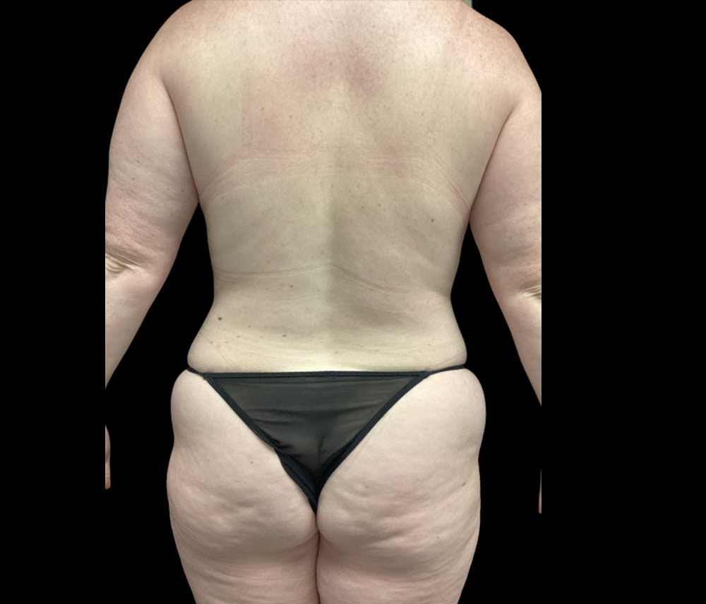 Liposuction Before & After Gallery - Patient 332432 - Image 11