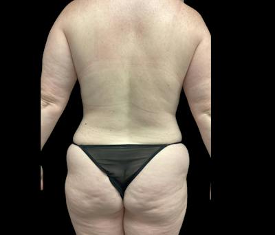 Liposuction Before & After Gallery - Patient 332432 - Image 11
