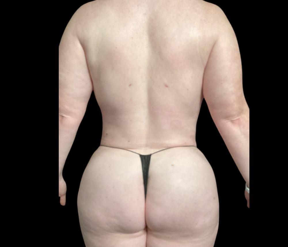 Liposuction Before & After Gallery - Patient 332432 - Image 12