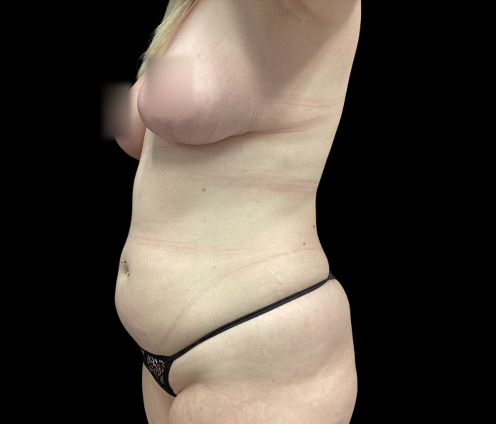 Liposuction Before & After Gallery - Patient 332432 - Image 7