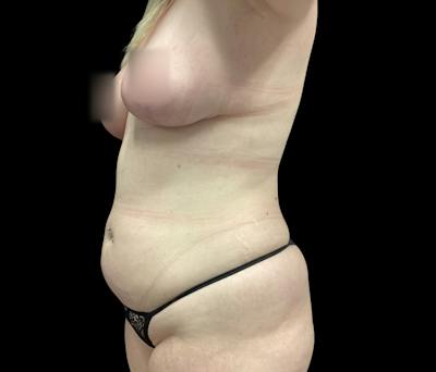 Liposuction Before & After Gallery - Patient 332432 - Image 7
