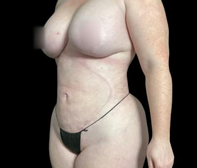 Liposuction Before & After Gallery - Patient 332432 - Image 8