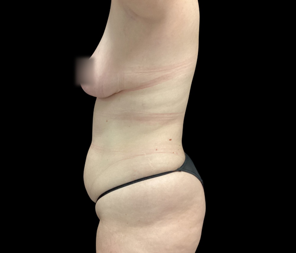 Liposuction Before & After Gallery - Patient 332432 - Image 9