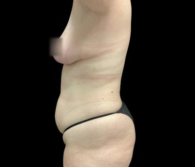 Liposuction Before & After Gallery - Patient 332432 - Image 9