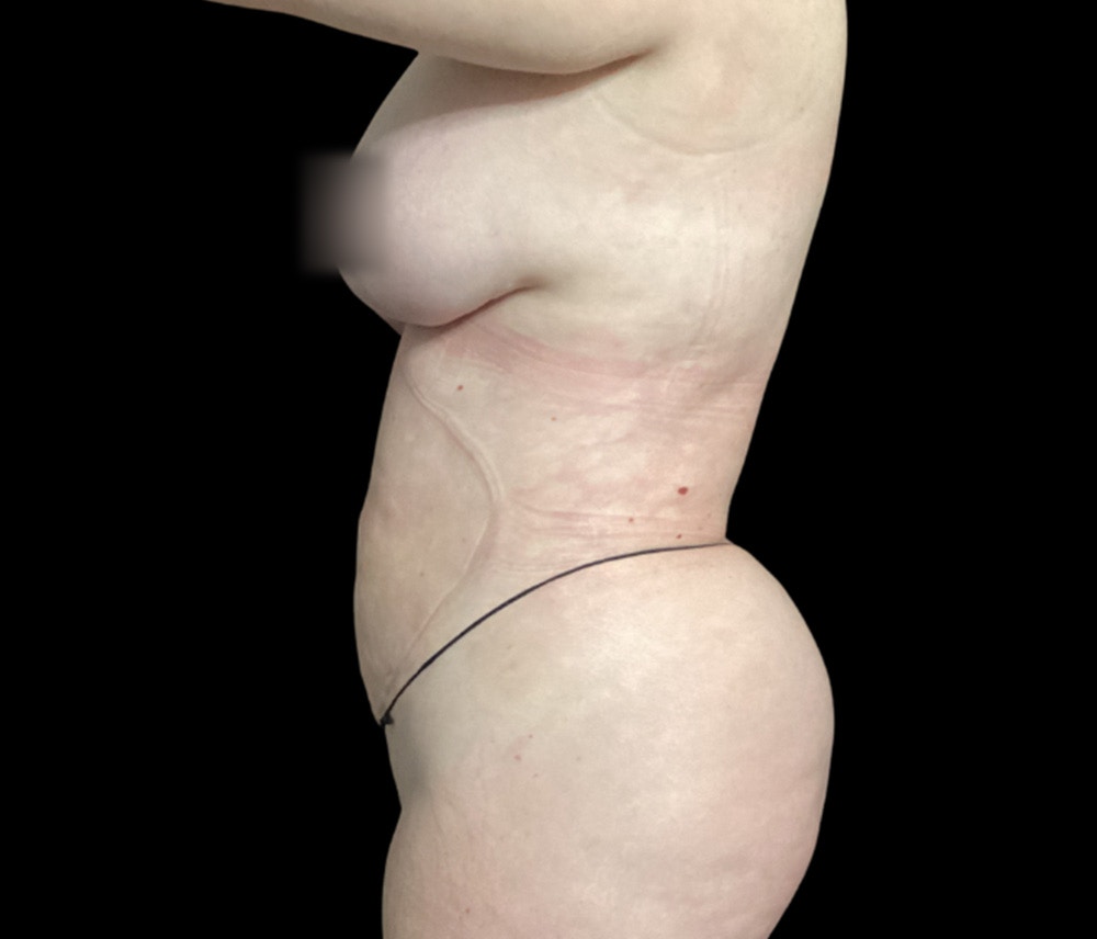 Liposuction Before & After Gallery - Patient 332432 - Image 10