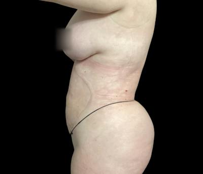 Liposuction Before & After Gallery - Patient 332432 - Image 10