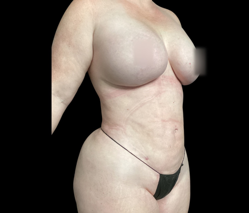 Liposuction Before & After Gallery - Patient 332432 - Image 4