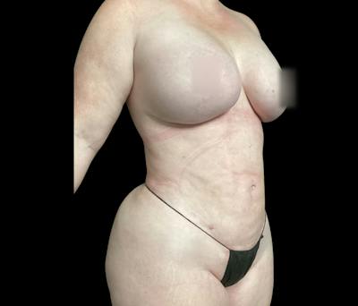 Liposuction Before & After Gallery - Patient 332432 - Image 4