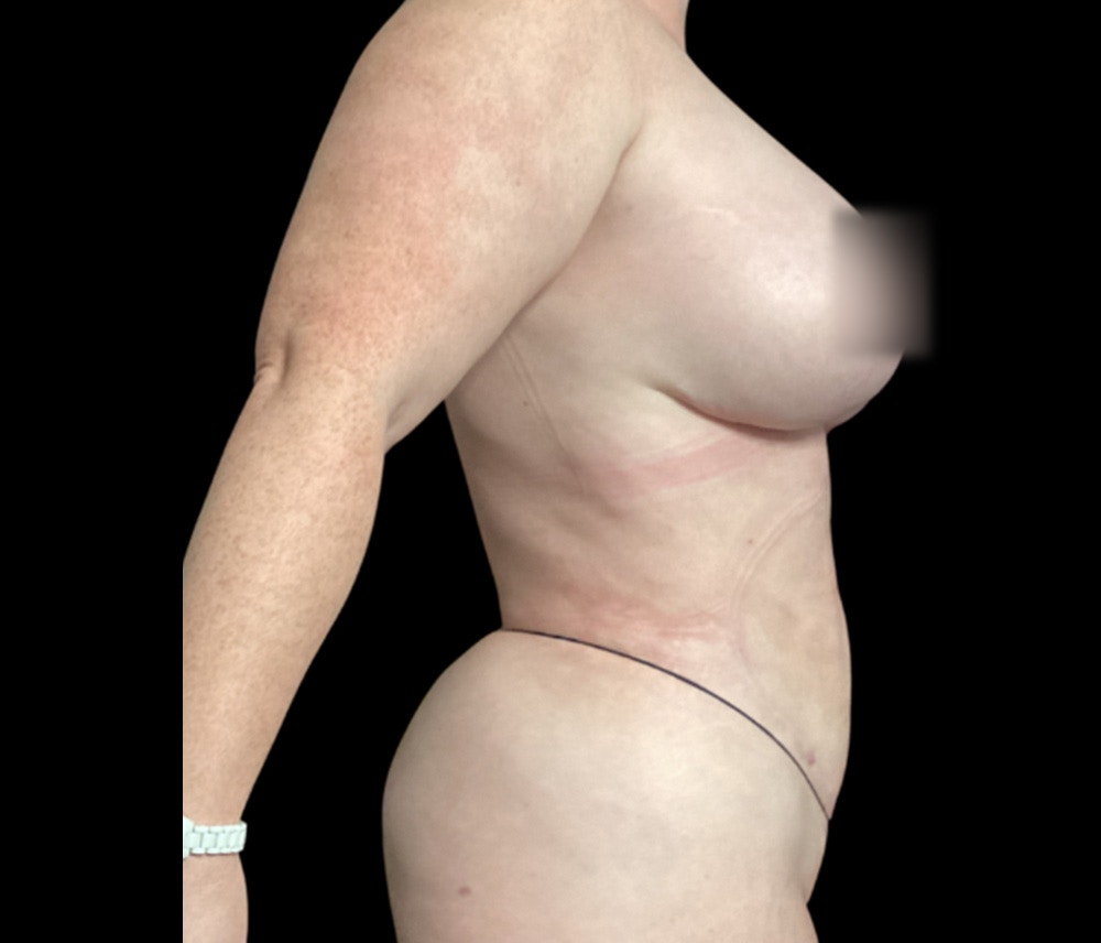 Liposuction Before & After Gallery - Patient 332432 - Image 6
