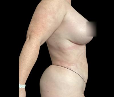 Liposuction Before & After Gallery - Patient 332432 - Image 6