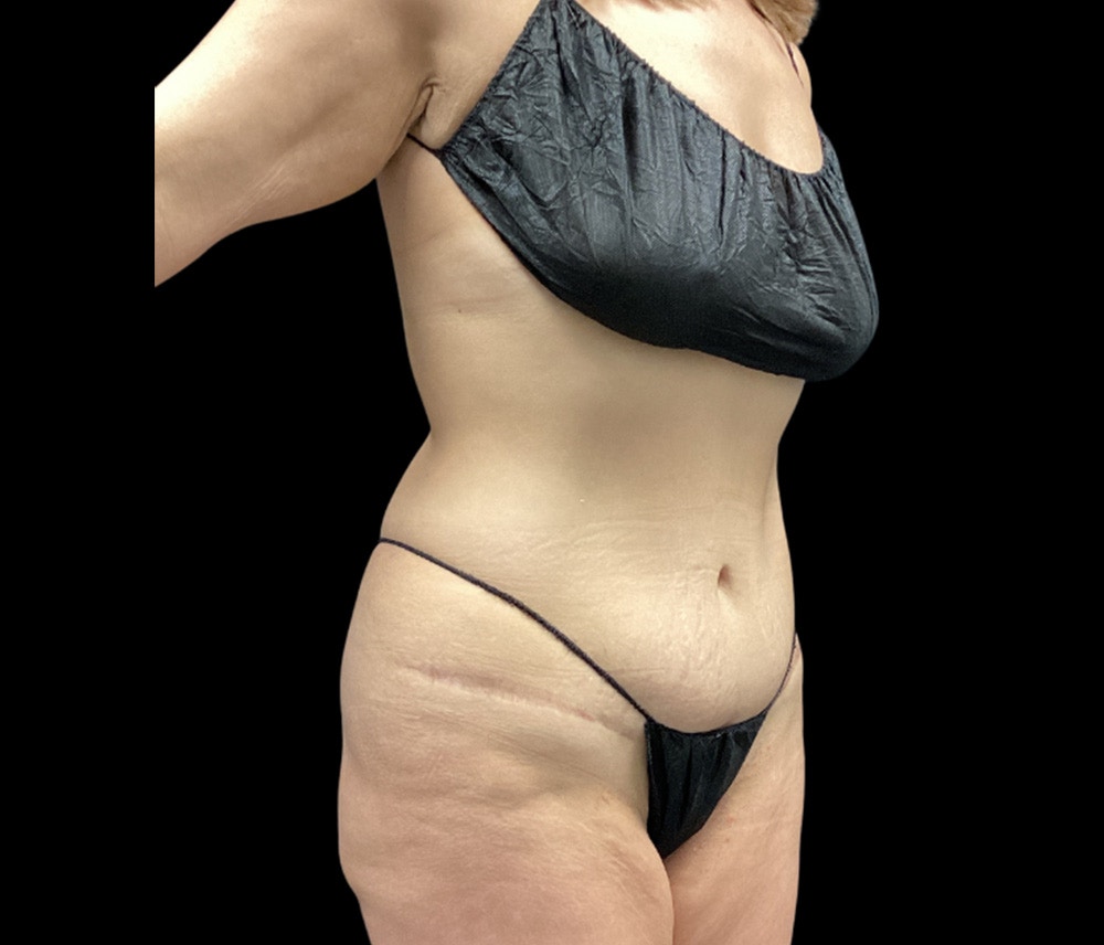 Liposuction Before & After Gallery - Patient 155293 - Image 3