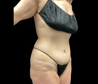 Liposuction Before & After Gallery - Patient 155293 - Image 3