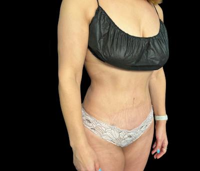 Liposuction Before & After Gallery - Patient 155293 - Image 4