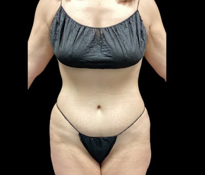 Liposuction Before & After Gallery - Patient 155293 - Image 1