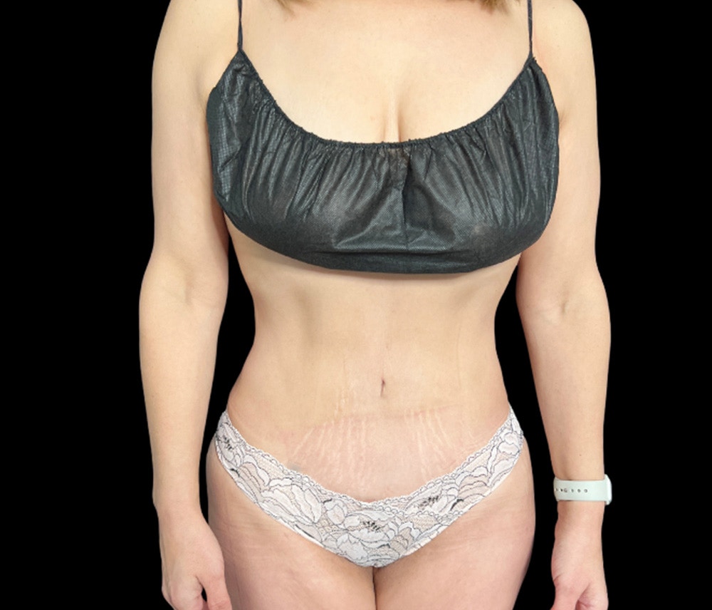 Liposuction Before & After Gallery - Patient 155293 - Image 2